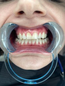 Profesionali dantų balinimo procedūra odontologijos klinikoje